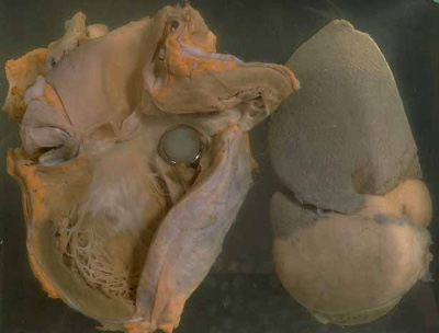 Heart Valve Implant Ball Valve Prosthesis in Heart