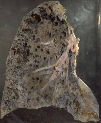 Smoker's Lung Pulmonary Emphysema
