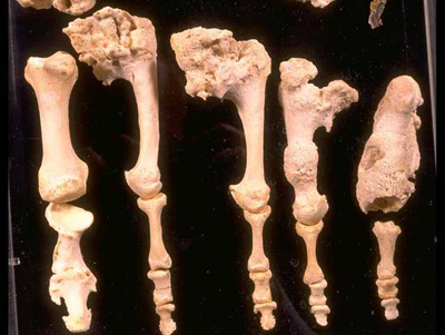 Syphilitic Bones Syphylitic Periostitis